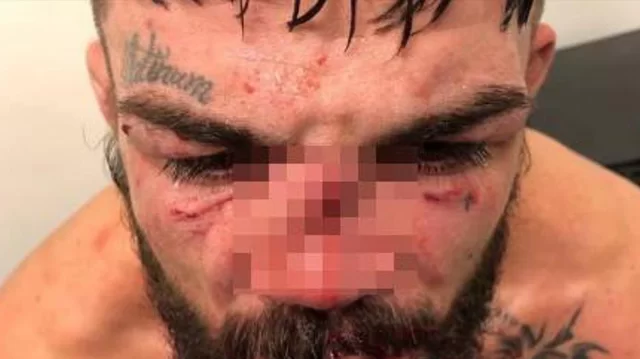 UFC: UZNEMIRUJUĆE FOTOGRAFIJE Stravičan lom nosa i unakažena arkada,oko- nakon žestokih borbi…